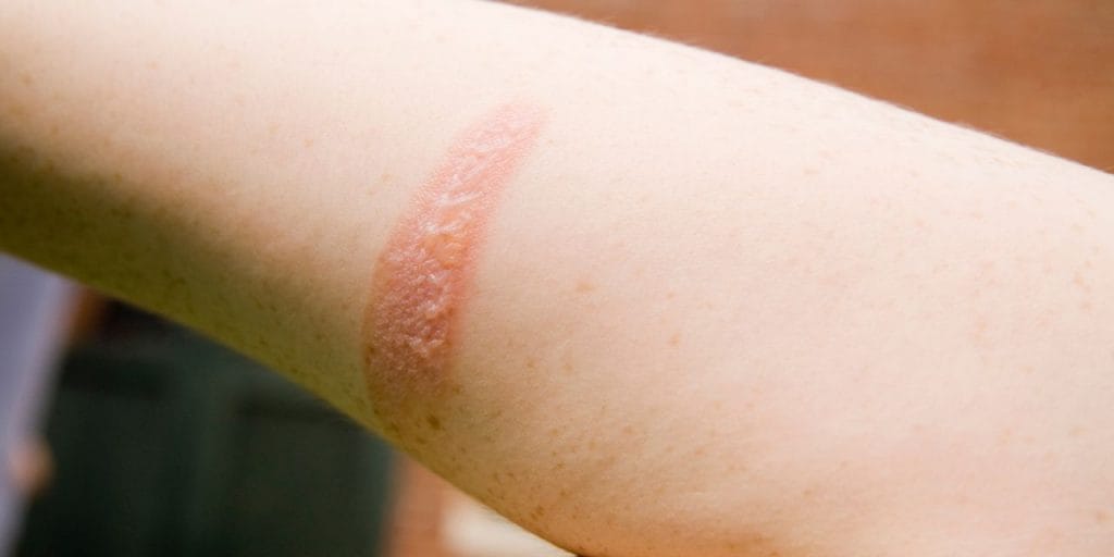 burned arm